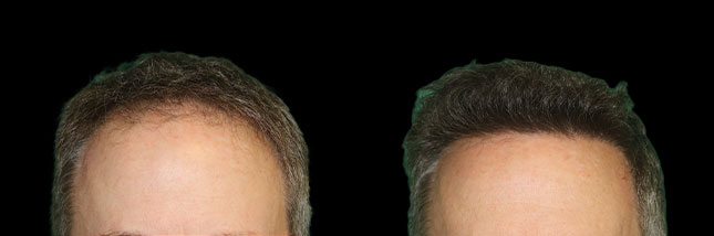 man's forehead showing thicker hair after an FUE hair transplant in Chicago by Dr. Sahar Nadimi.