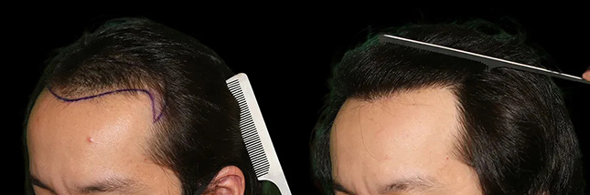 man's forehead showing thicker hair after an FUE hair transplant in Chicago by Dr. Sahar Nadimi.