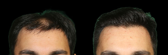 man's forehead showing thicker hair after an FUE hair transplant in Chicago by Dr. Sahar Nadimi.