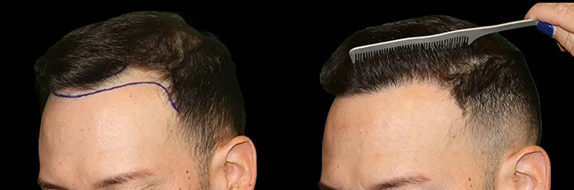 man's forehead showing thicker hair after an FUE hair transplant in Chicago by Dr. Sahar Nadimi.