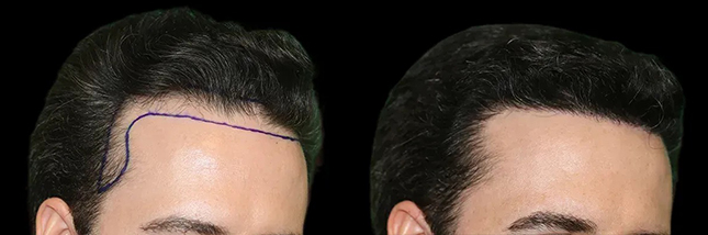 man's forehead showing thicker hair after an FUE hair transplant in Chicago by Dr. Sahar Nadimi.