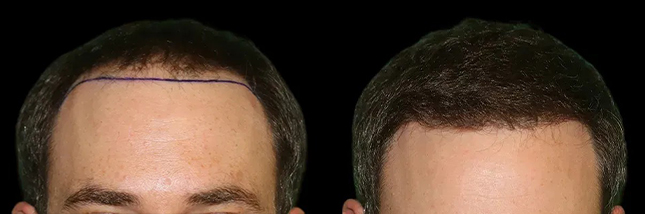 man's forehead showing thicker hair after an FUT hair transplant in Chicago by Dr. Sahar Nadimi.