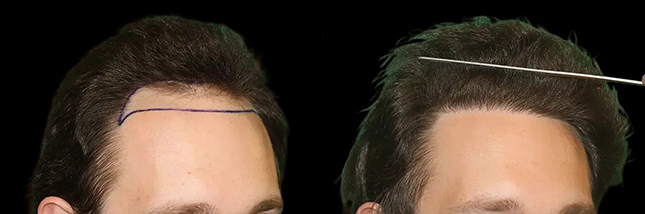 man's forehead showing thicker hair after an FUT hair transplant in Chicago by Dr. Sahar Nadimi.