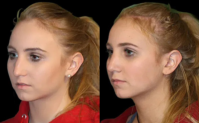 A young woman's before and after primary rhinoplasty results in Chicago.