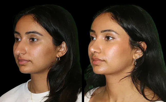 Before and after results of a woman's primary rhinoplasty in Chicago.