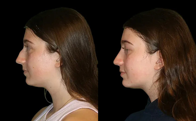 A profile view a woman's Chicago primary rhinoplasty results.
