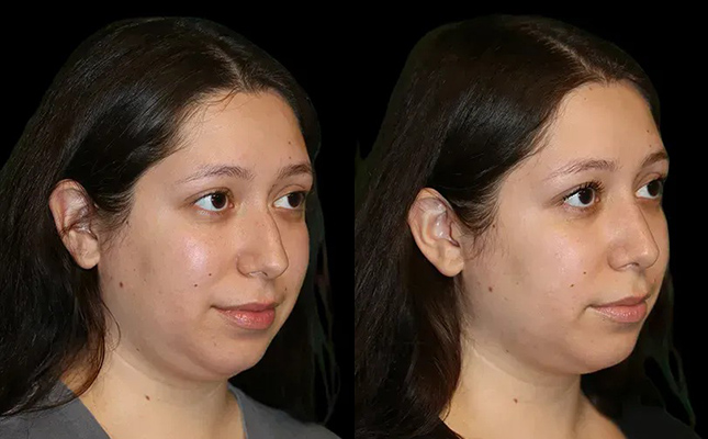A woman's before and after primary rhinoplasty results in Chicago.