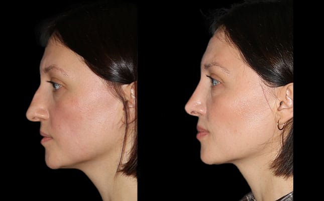 A woman poses for her before and after results after a primary rhinoplasty in Chicago.